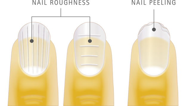 Nail damages image by S-C-Nutrition.
